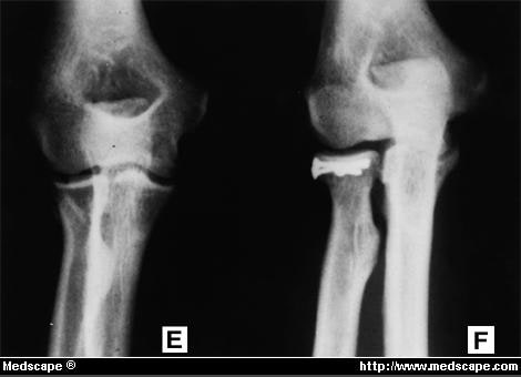 Restoring Elbow Stability After Fracture-Dislocation: Part II - Page 3