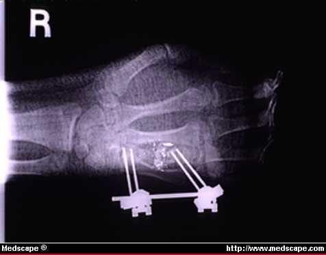 Treatment of Hand Fractures with External Fixation - Page 3