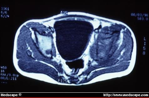 Needle Biopsies of Bone Tumors