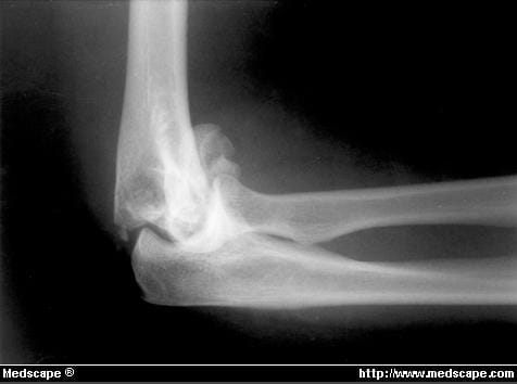 The Role Of The Compass Elbow Hinge In The Operative Treatment Of 