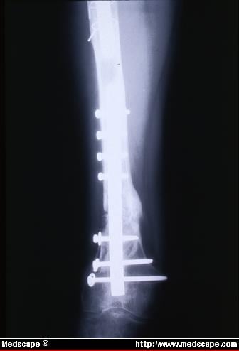 comminuted supracondylar femur intercondylar distal severely fractures intramedullary