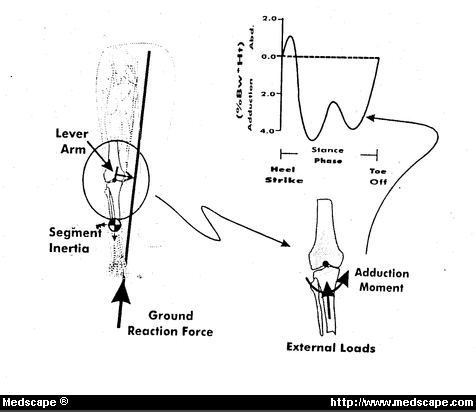 Hemicallotasis: A New Procedure for Arthritic Knees - Page 2