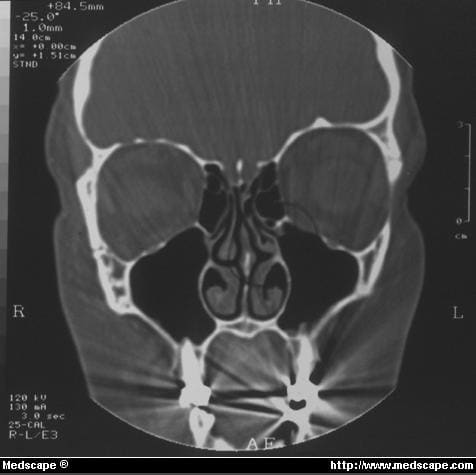 Functional Endoscopic Sinus Surgery for Sinusitis - Page 3