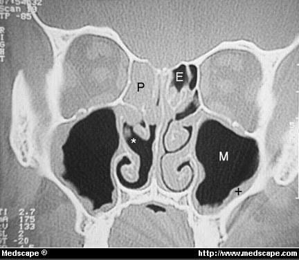 Sinusitis: A Practical Guide for Physicians - Page 6