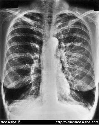 Alpha1-Antitrypsin Deficiency in COPD: Clinical Implications