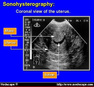 Contemporary Concepts in Managing Menorrhagia - Page 5