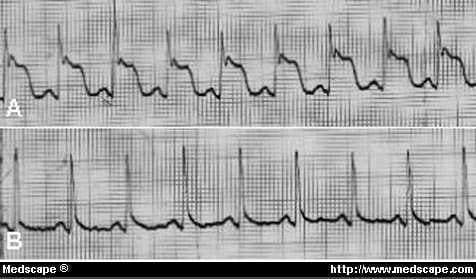 Assessing Coronary Artery Disease in Women