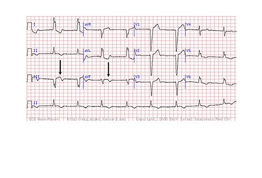 Septaler Infarkt Ekg Alter Unbestimmt deutsch.medscape.com