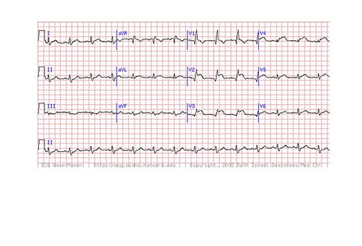 Diskrete Infarktzeichen Im Ekg Medscape