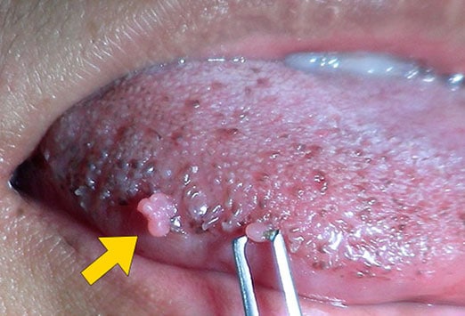 Uvula papilloma symptoms - Hpv uvula papilloma, Papilloma wart uvula, Papiloma faringeo tratamiento