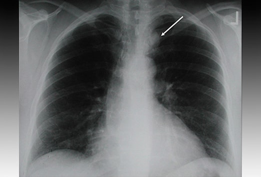 Thoraxrontgen Das Sollten Sie Nicht Ubersehen Medscape