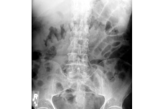 Radiologische Bildgebung von Magen-Darm-Erkrankungen | Medscape