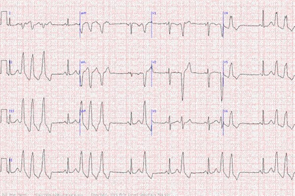 Fallstudie: EKG-Auswertung vor der Operation bei einem alten Mann