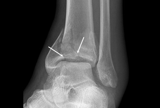 Verletzungen des Sprunggelenks Slideshow Medscape