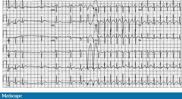 Quiz : Drei Fragen ein EKG betreffend | Medscape
