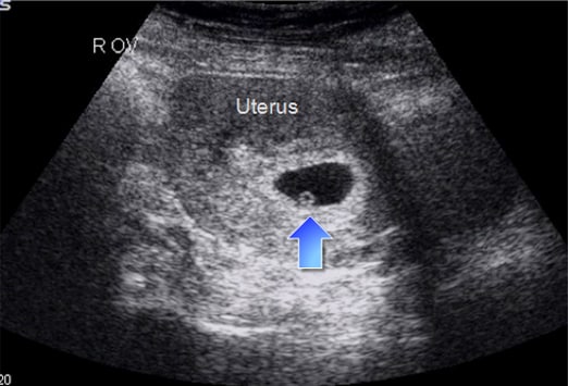 Ultraschall gebärmutter ohne schwangerschaft