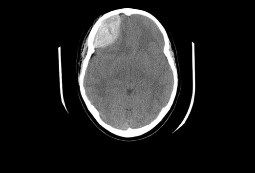 Ct Schadel Quiz Erkennen Sie Alle Befunde Medscape