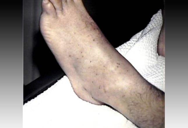 Chronische Leukämien: Bildergalerie zu Diagnose und Therapie
