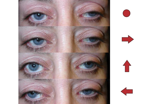 oculomotorius parese diabetes mellitus