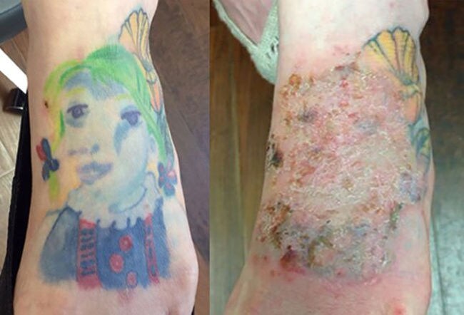 Schöner Schlamassel Manche Tattoos sind ein Fall für den Arzt