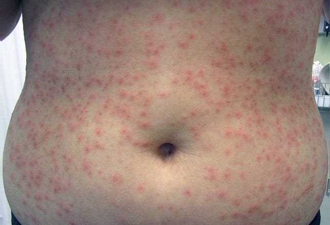 Legionella Skin Rash Mini-Lexikon der Haut-Ausschläge (Teil 2): Bakterien als Übeltäter ...