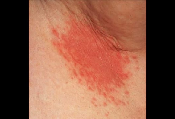 Intertrigo behandlung INVERSE PSORIASIS