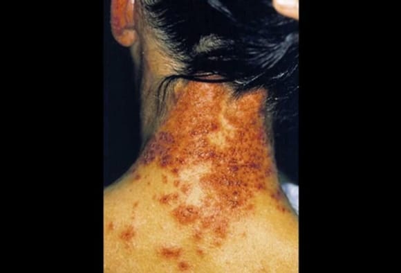 Diashow: Kontaktdermatitis  Ursachen, Symptome und Behandlung im  berblick. Wissen aus der Praxis fr die Praxis