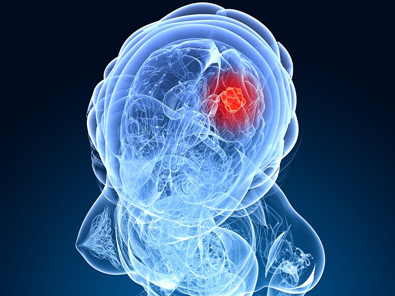 Elektrische Felder gegen das Glioblastom