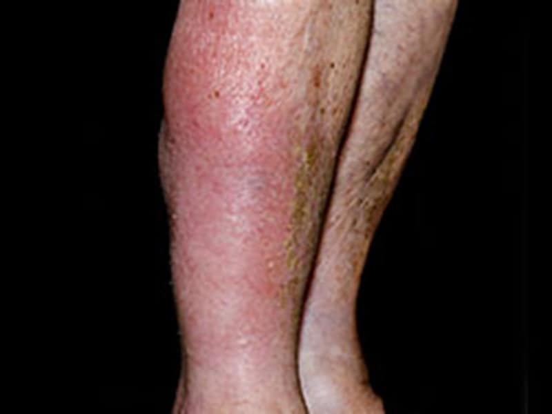 Quiz am Montag: Therapie und Diagnose von Phlegmone