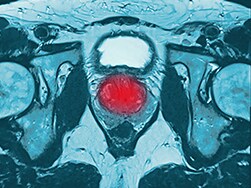 Quiz zum Prostatakarzinom: Die aktuellen Empfehlungen zu Therapie und Diagnose