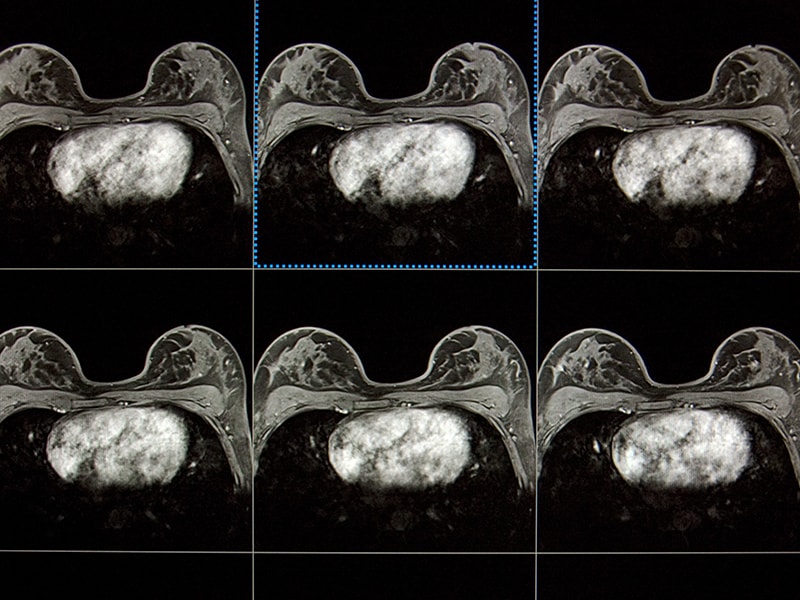MRT oder Mammografie: Was ist besser zum Brustkrebs-Screening?