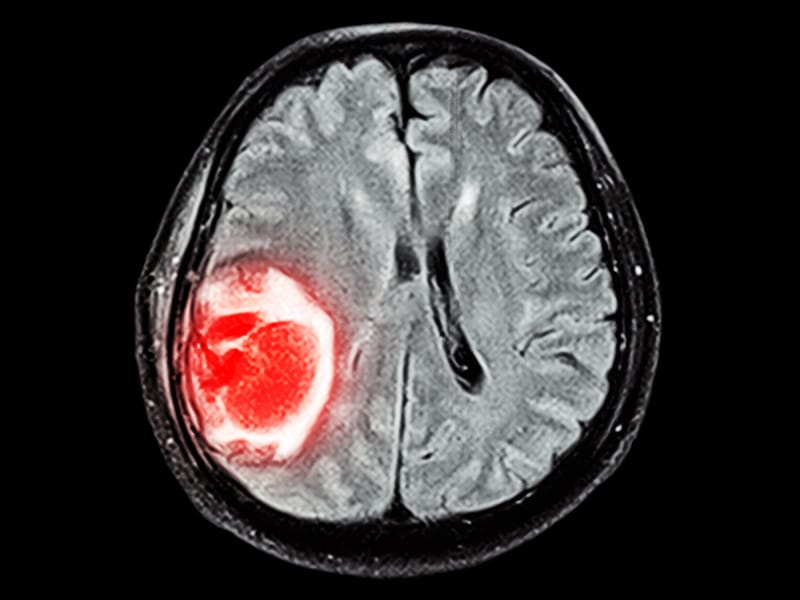 Hirnmetastasen Stereotaktische Radiochirurgie auf Erfolgskurs?
