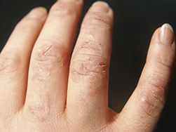 Montags Quiz 5 Fragen Zur Kontaktdermatitis