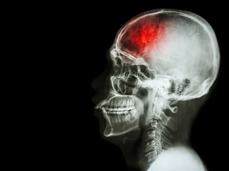 PFO-Verschluss bei kryptogenem Schlaganfall: Neue Leitlinie