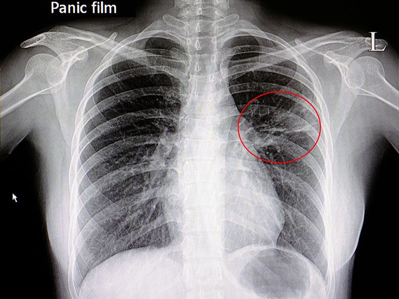 Lungenentzündung: Tipps Zu Diagnose Und Risiko-Stratifizierung