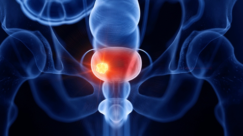 Metastasiertes Blasenkarzinom: 7 Monate länger leben mit Avelumab
