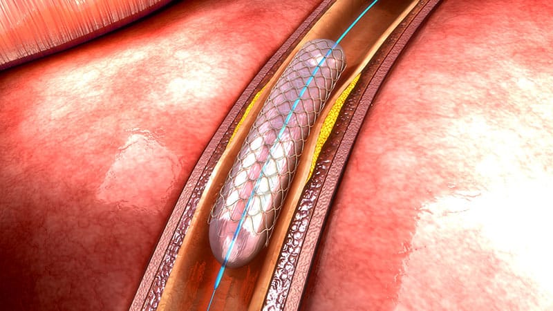 Entwarnung bei PAVK: Paclitaxel-Stents erhöhen doch nicht Sterblichkeit