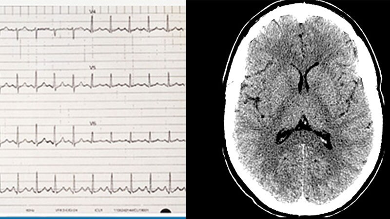 Fall Ein 30jähriger Mann mit Paranoia und Erbrechen nach einer Party