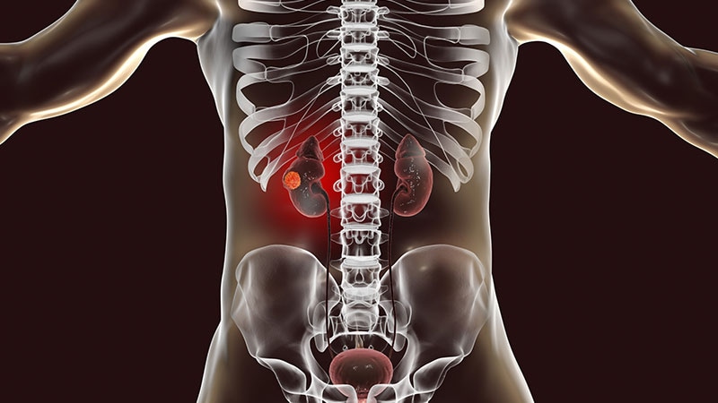 Klarzelliges Nierenzellkarzinom: Länger überleben mit Pembrolizumab