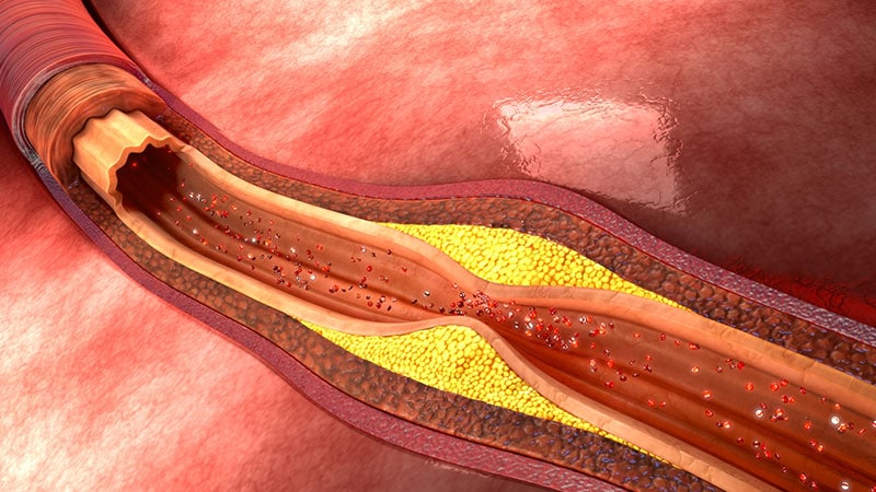 Neuartige Ansätze in der Lipidtherapie: Antisense-Nukleotide und Gen-Silencing reduzieren Cholesterin und Lipoprotein(a)