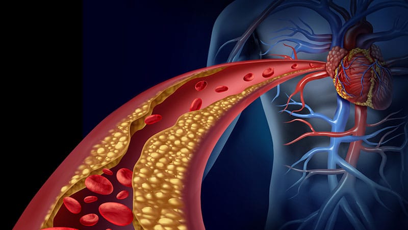 Lipidsenkung: Zielwerte und die Wege dorthin 