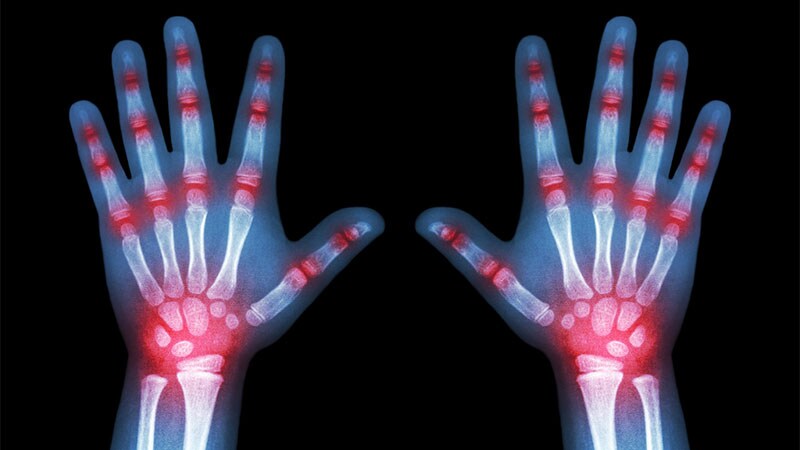 Medikamentöse Prophylaxe der rheumatoiden Arthritis wo stehen wir?