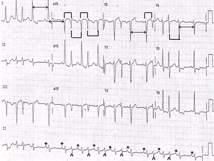ekg-quiz-hyperlipid-mie-und-rhythmusst-rung-was-fehlt-diesem-mann