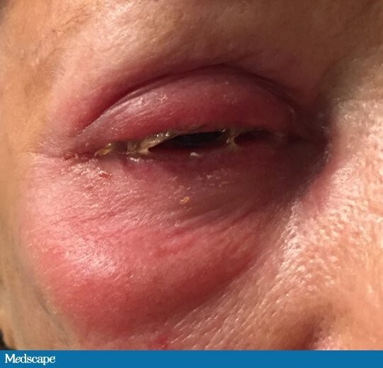 tipos de celulitis en el ojo