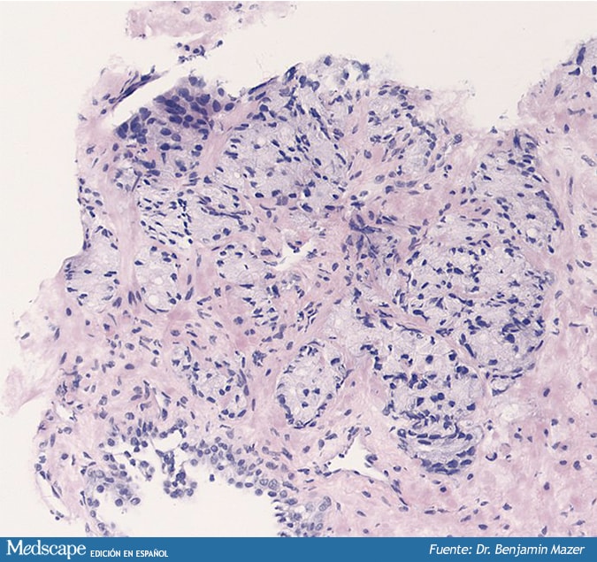 publicar para biopsia de próstata operacion