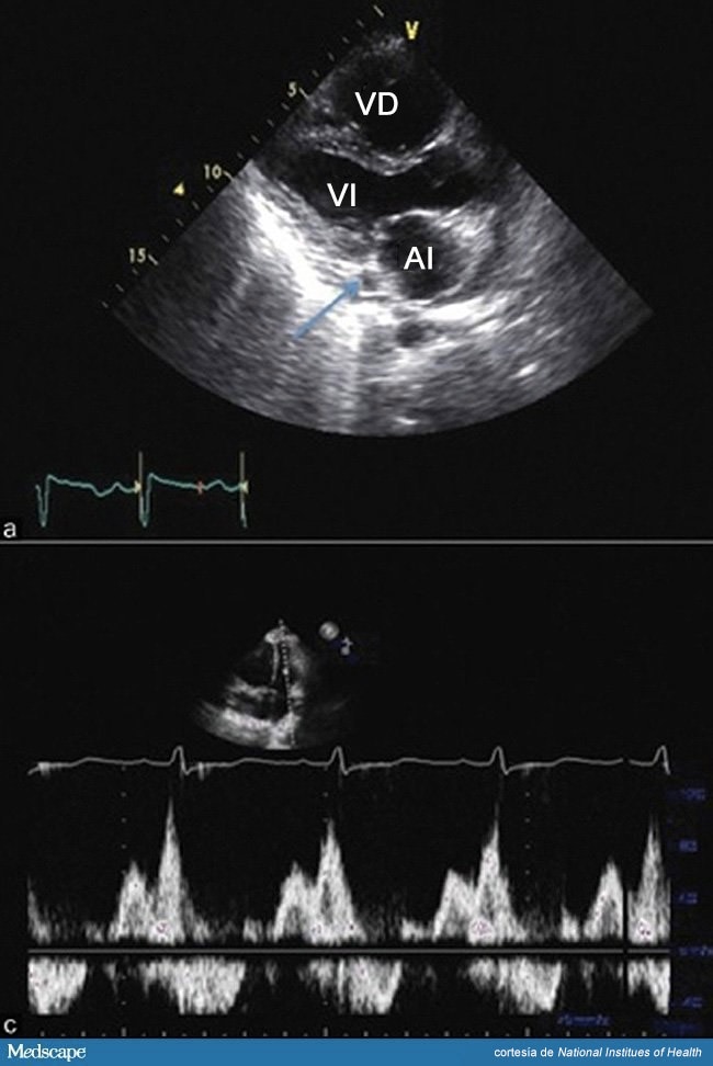 VIH e hipertensión arterial pulmonar unha revisión sistemática