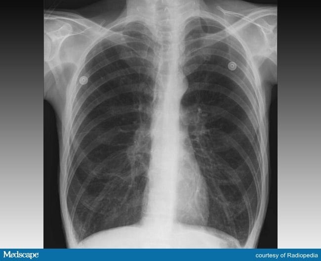 Errores diagn sticos en pacientes con s ntomas pulmonares