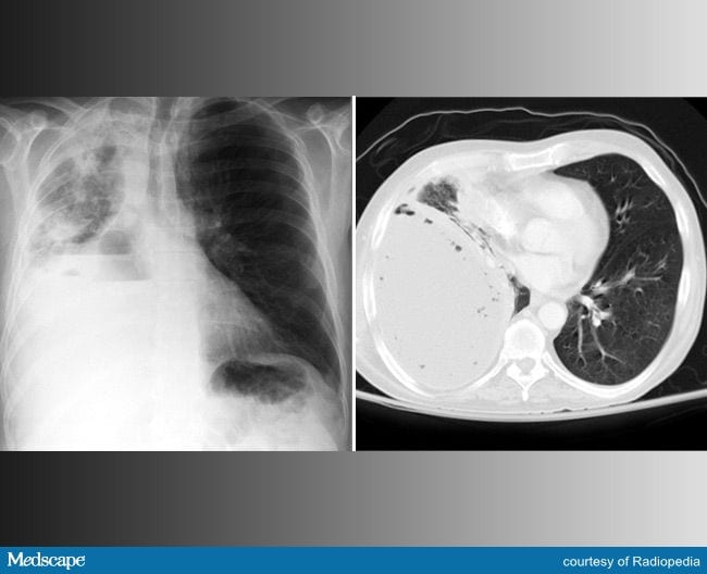Errores diagn sticos en pacientes con s ntomas pulmonares page 4