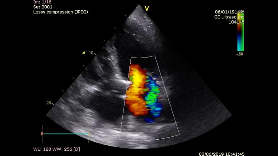 ecocardiograma de insuficiencia cardiaca