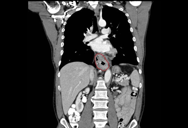 radiografía de cáncer de esófago